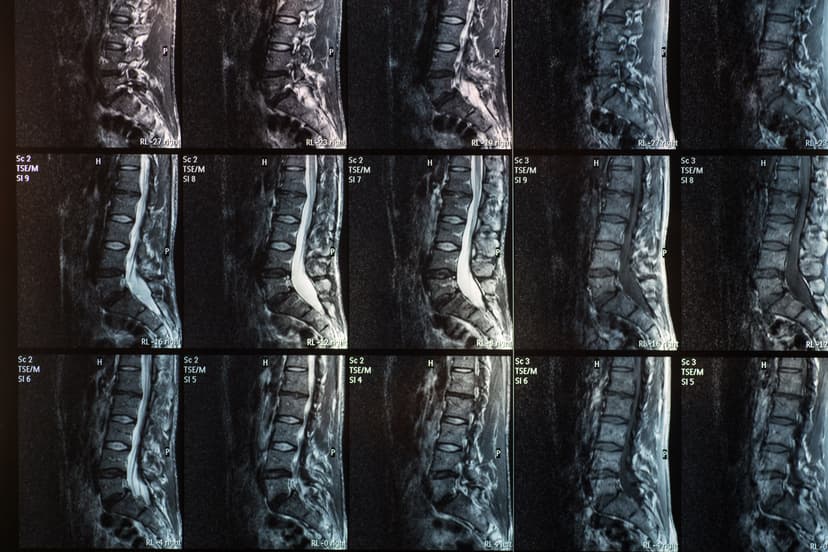 Radiology of Spondylolisthesis