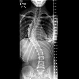 Picture of Scoliosis